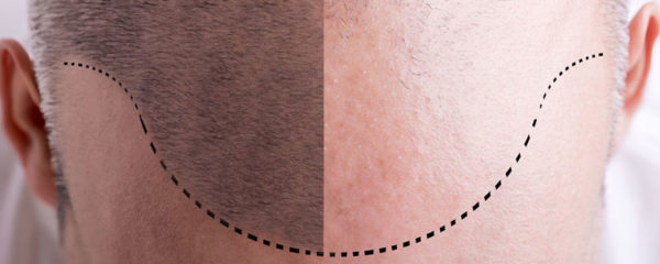 hair transplant